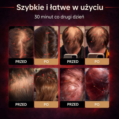 Czapka z laserem na porost włosów